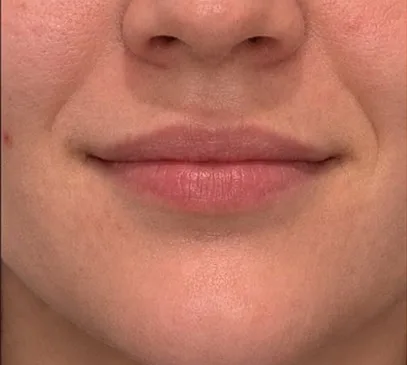 Close view of adult lip anatomy used to discuss movement and proportion during lip assessment