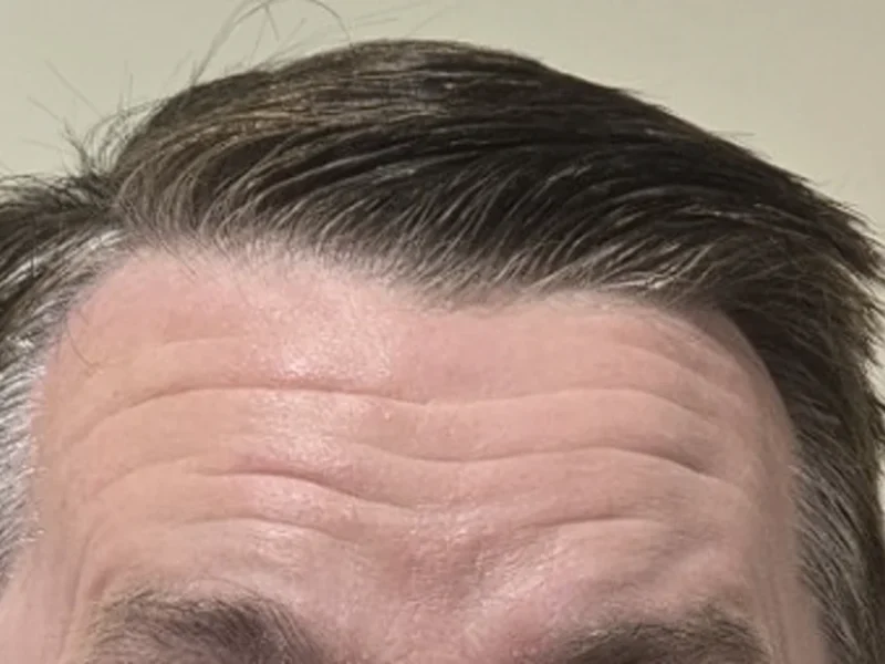 Wrinkle and upper-face consultation assessment at Core Aesthetics in Oakleigh