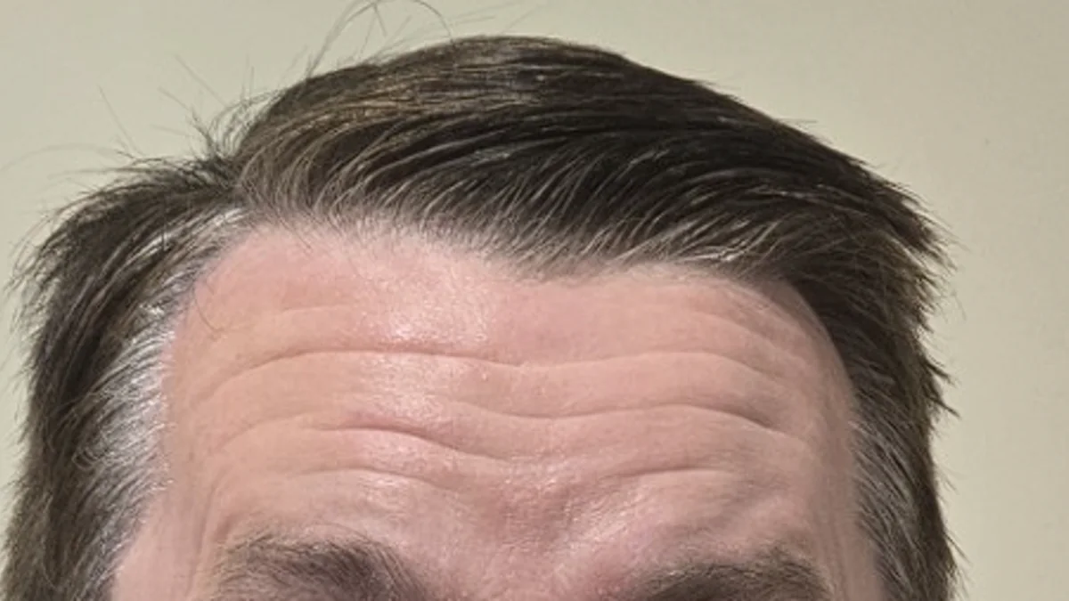 Wrinkle and upper-face consultation assessment for consultation planning at Core Aesthetics in Oakleigh