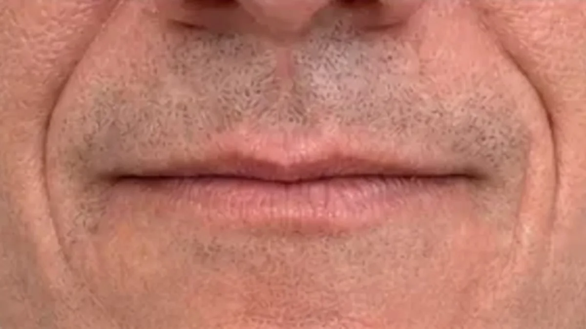 Lip and perioral consultation assessment for consultation planning at Core Aesthetics in Oakleigh