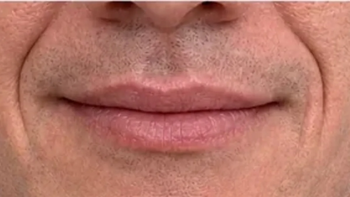 Lip and perioral consultation assessment for consultation planning at Core Aesthetics in Oakleigh