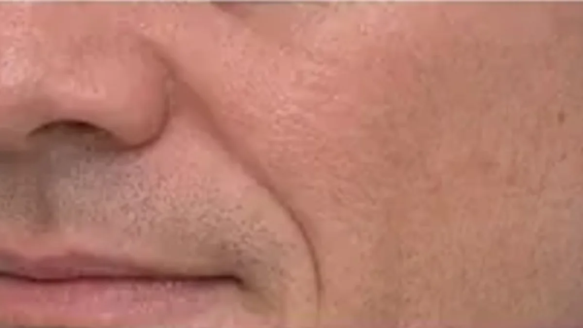 Lip and perioral consultation assessment for consultation planning at Core Aesthetics in Oakleigh
