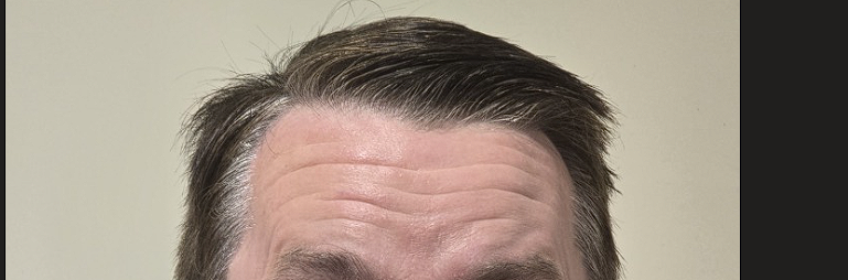 Wrinkle and upper-face consultation assessment for consultation planning at Core Aesthetics in Oakleigh