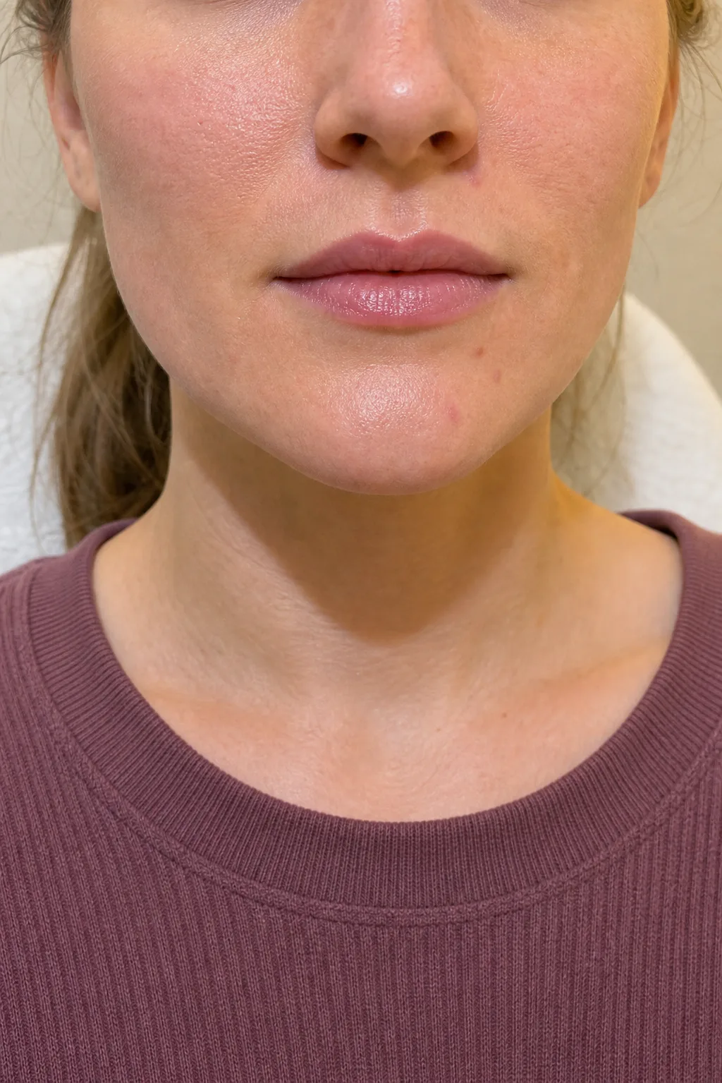 Adult female staff model showing a relaxed lower face for lip consultation planning