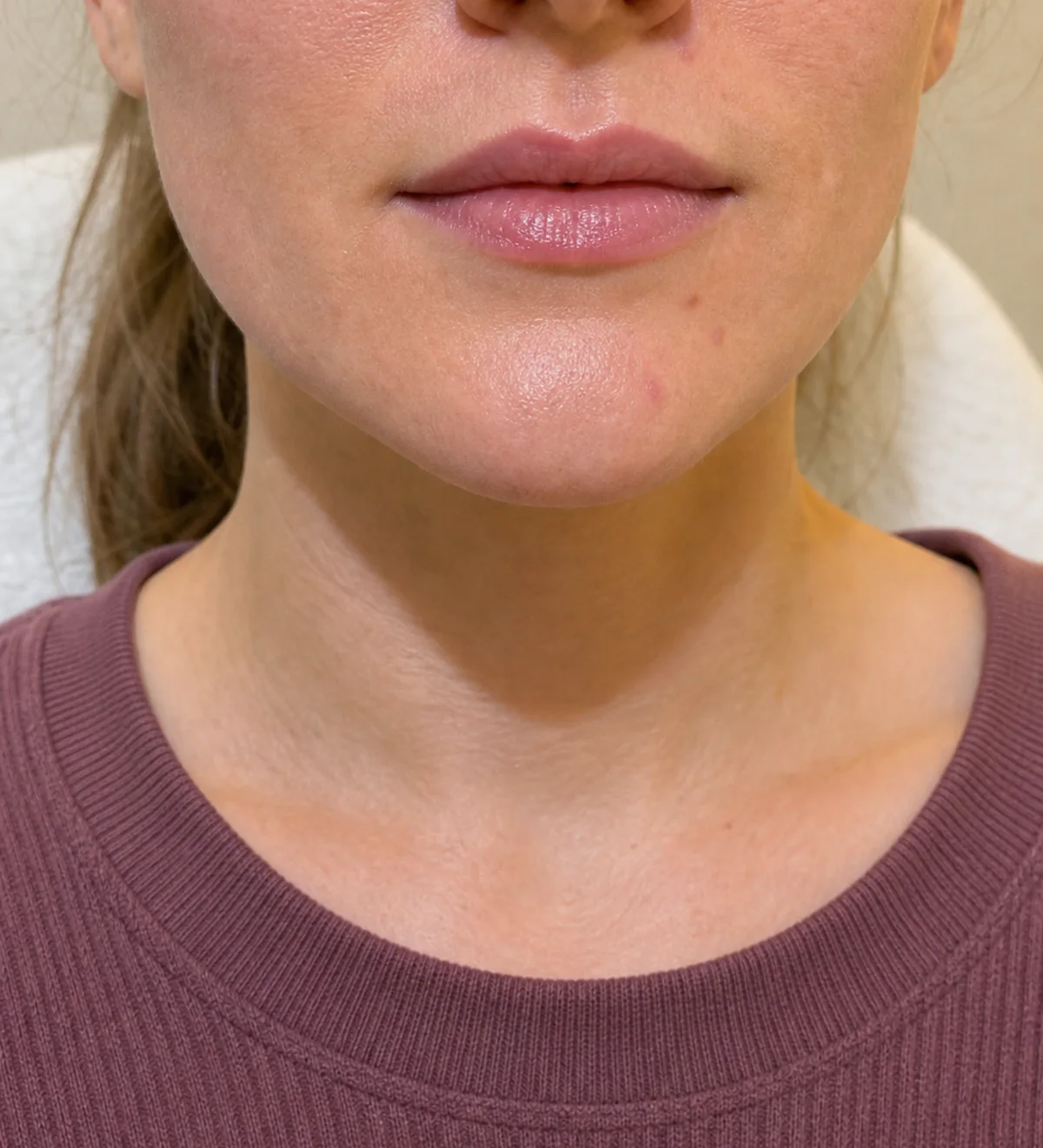 Lip and perioral consultation assessment for consultation planning at Core Aesthetics in Oakleigh