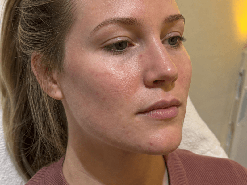 Natural facial skin texture shown in neutral clinic lighting