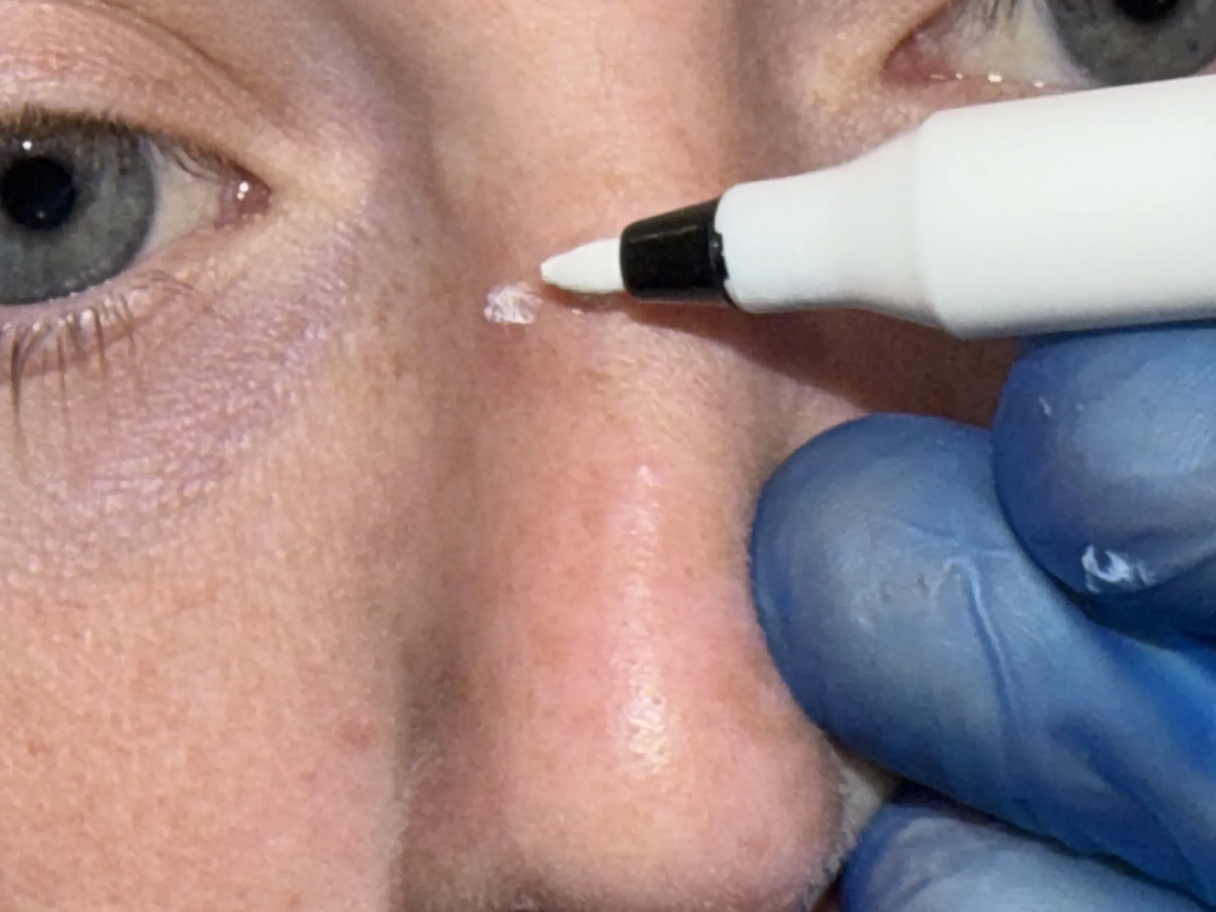 Wrinkle and upper-face consultation assessment for consultation planning at Core Aesthetics in Oakleigh