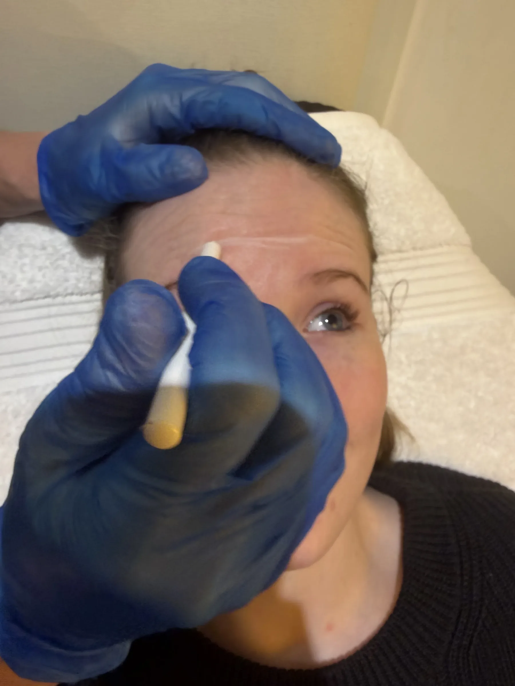 Wrinkle and upper-face consultation assessment for consultation planning at Core Aesthetics in Oakleigh