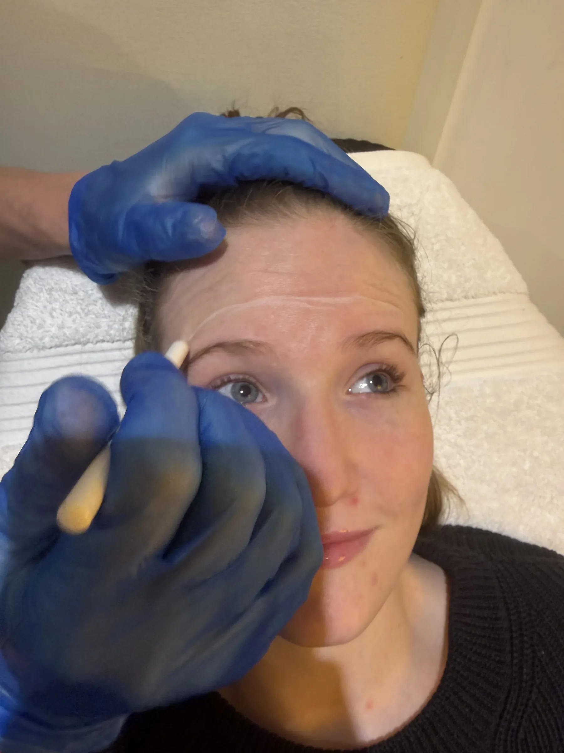 Wrinkle and upper-face consultation assessment for consultation planning at Core Aesthetics in Oakleigh