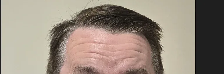 Wrinkle and upper-face consultation assessment for consultation planning at Core Aesthetics in Oakleigh