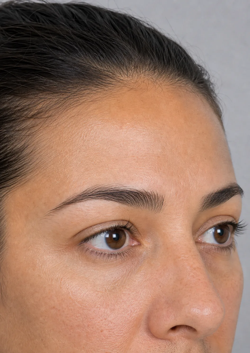 Wrinkle and upper-face consultation assessment for consultation planning at Core Aesthetics in Oakleigh