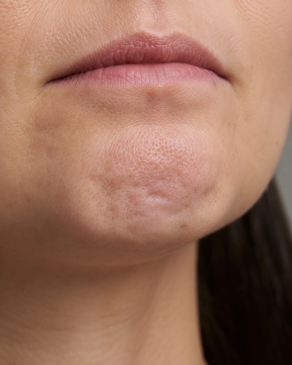 Chin and jawline consultation assessment for consultation planning at Core Aesthetics in Oakleigh