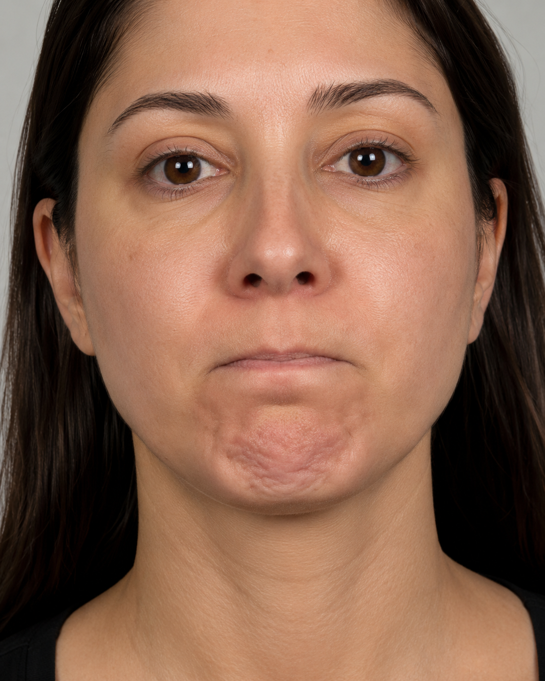 Chin dimpling movement assessment reference for consultation at Core Aesthetics Oakleigh