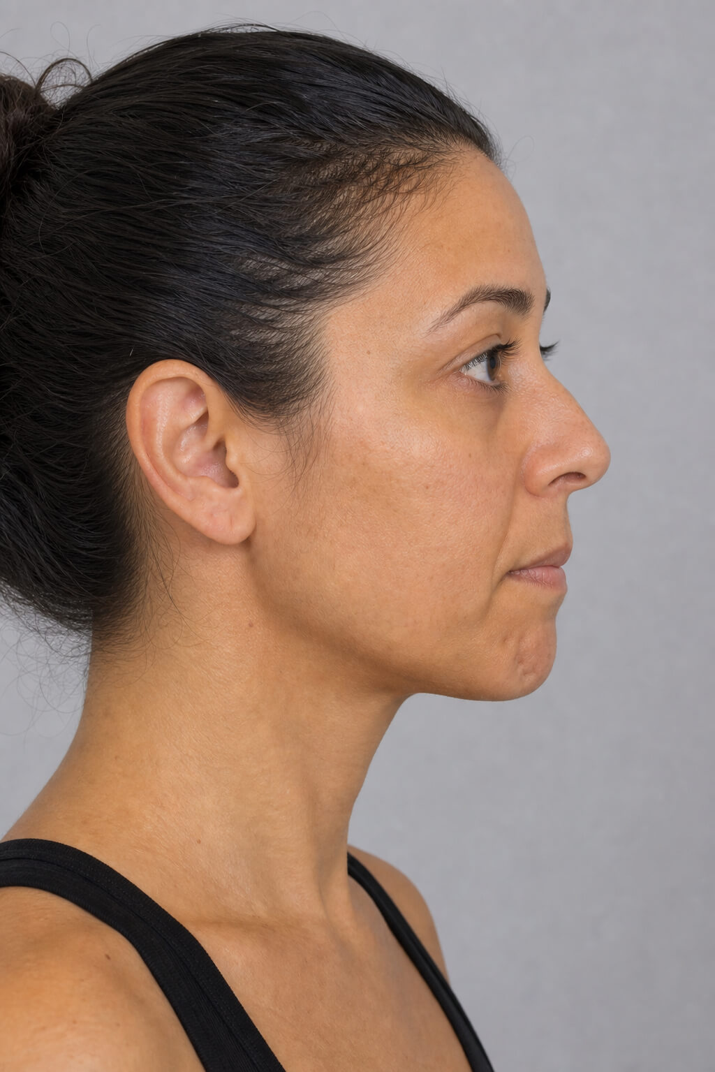 Chin side profile assessment reference for chin consultation at Core Aesthetics Oakleigh