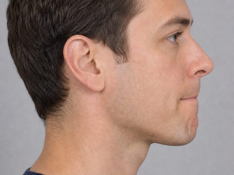 Core Aesthetics core aesthetics chin male side 02