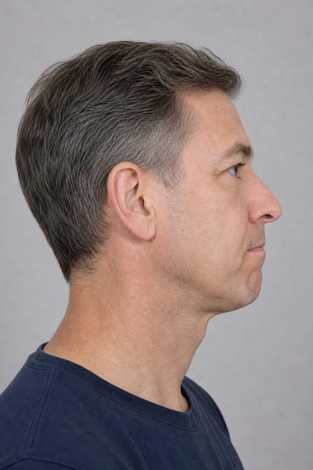 Adult man shown in side profile during a jawline and lower-face assessment discussion