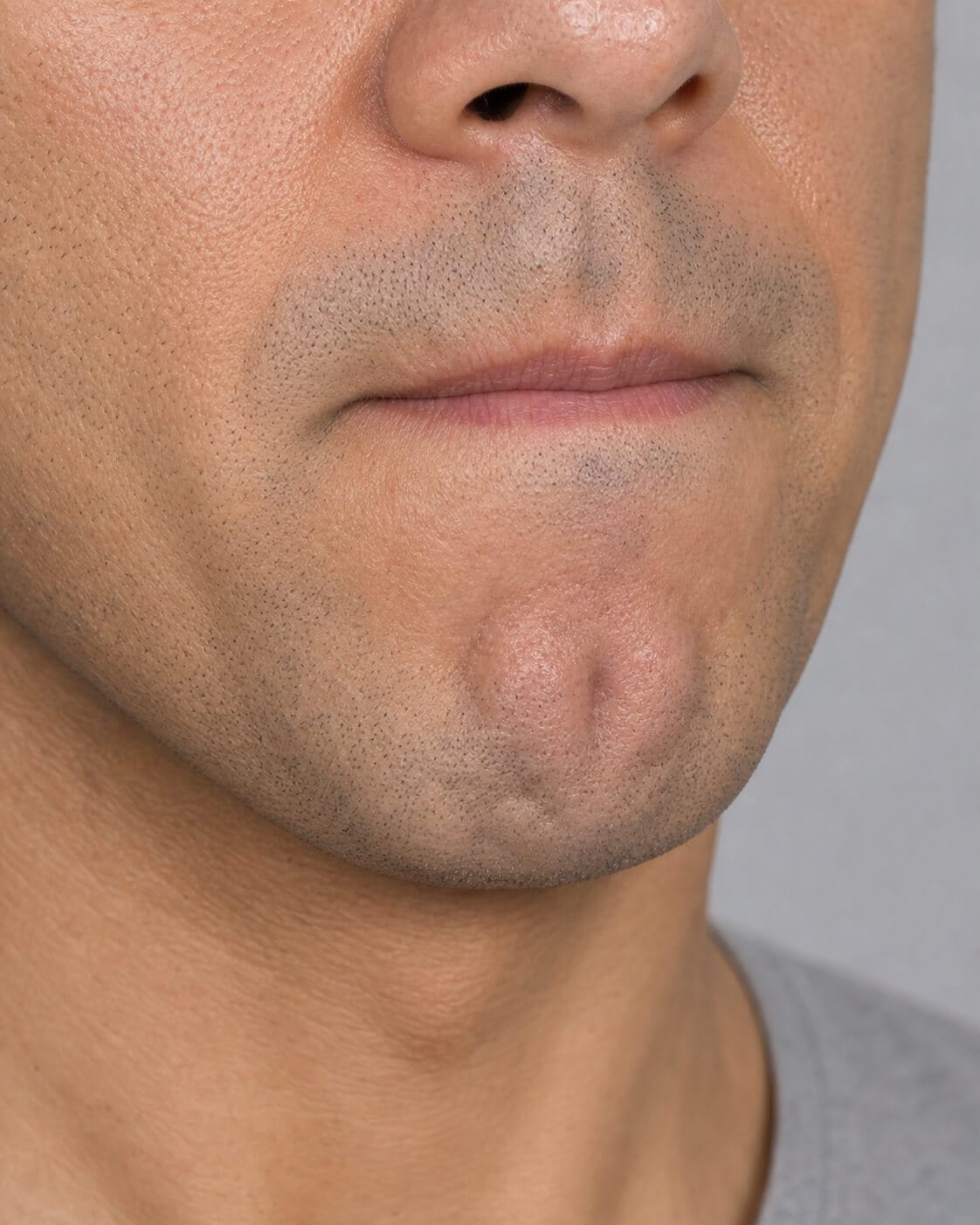 Adult patient in side view for a jawline, chin and lower-face assessment discussion