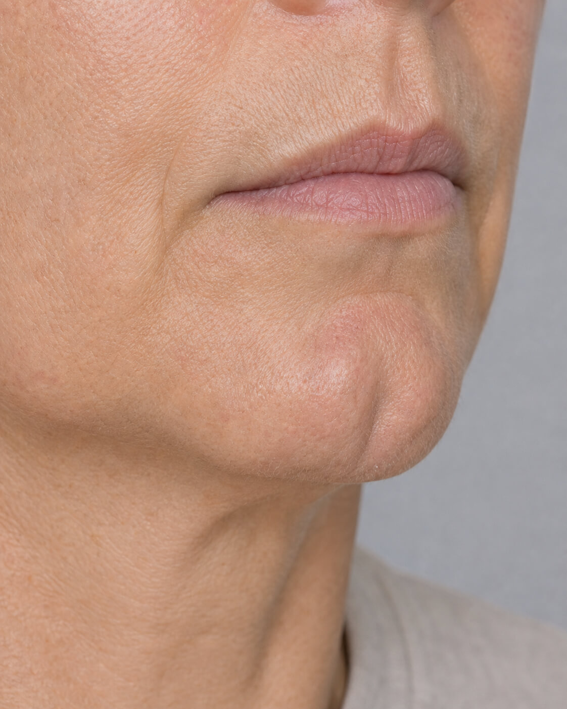 Chin and jawline consultation assessment for consultation planning at Core Aesthetics in Oakleigh