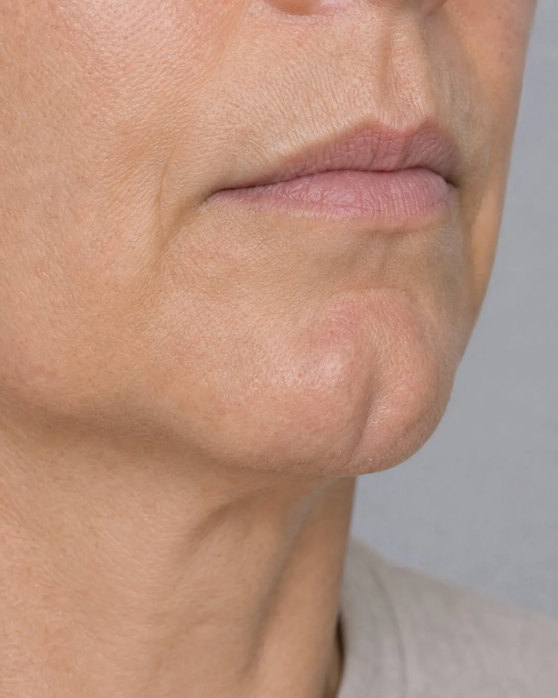 Adult patient in side view for a lower-face profile and jawline assessment discussion
