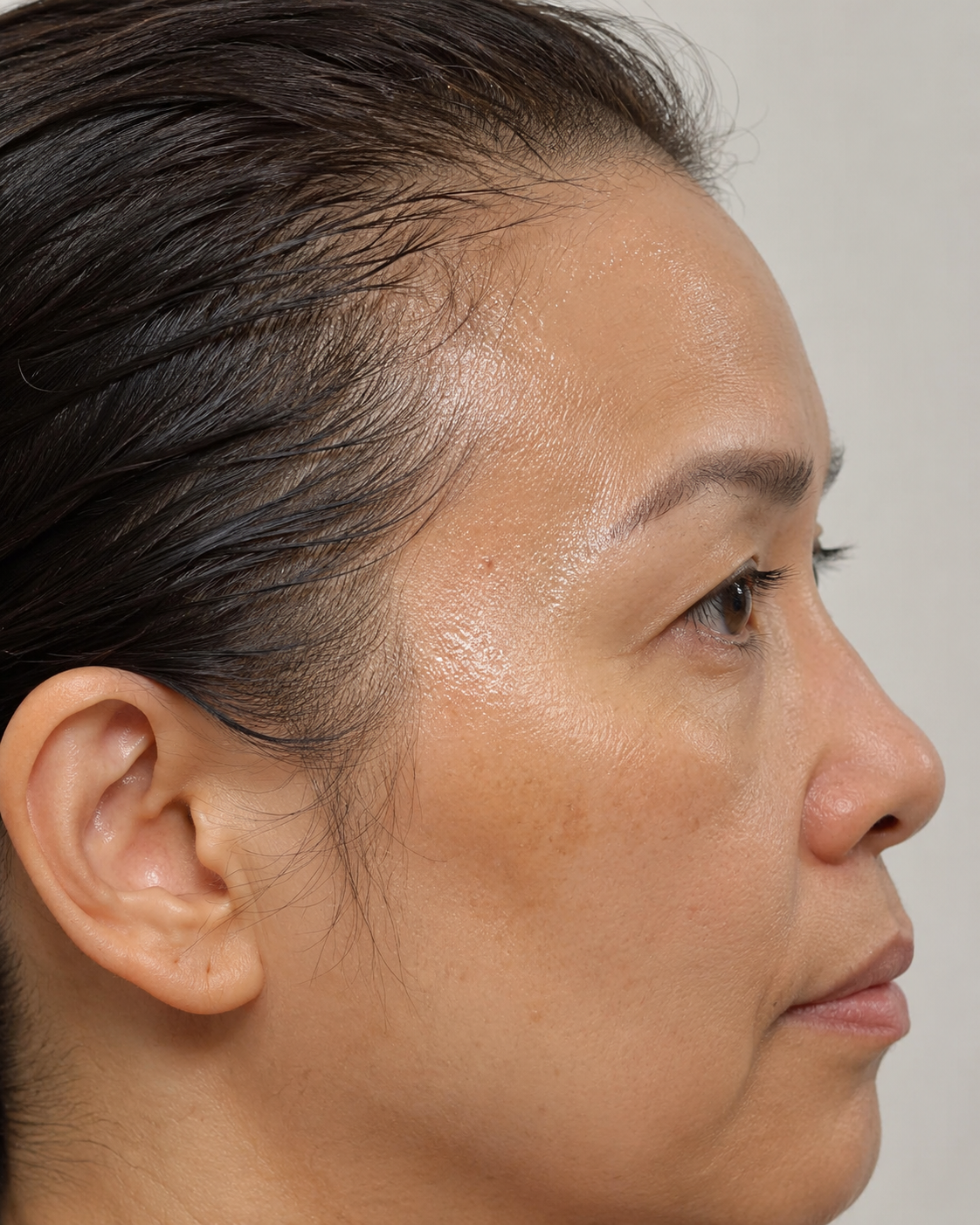 Underarm sweating consultation assessment for consultation planning at Core Aesthetics in Oakleigh