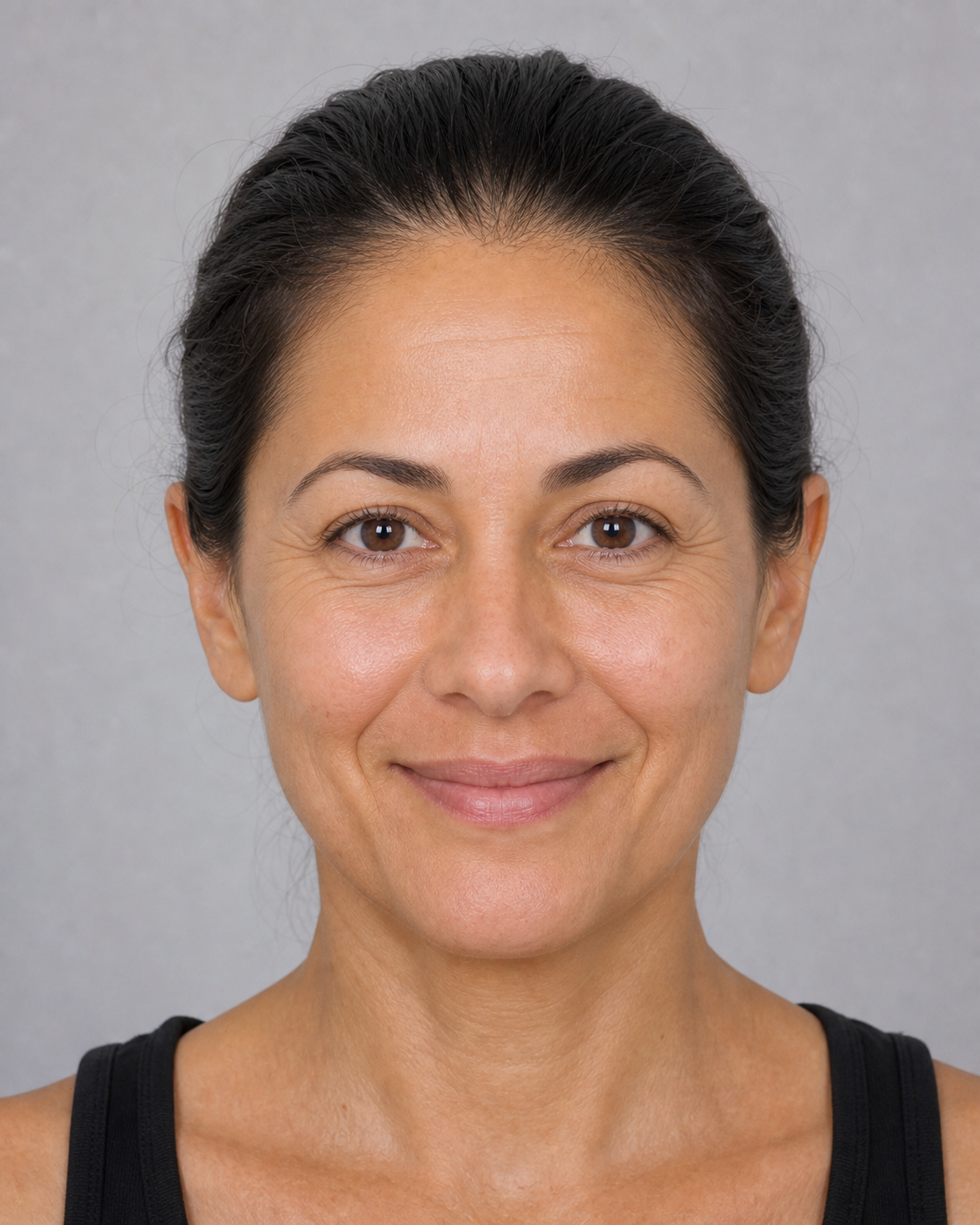 Outer eye smile line assessment reference for crows feet consultation at Core Aesthetics Oakleigh