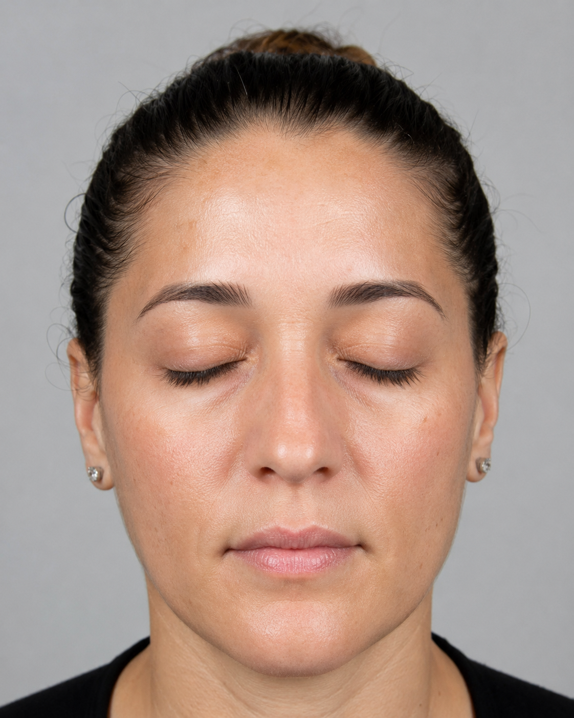 Wrinkle and upper-face consultation assessment for consultation planning at Core Aesthetics in Oakleigh