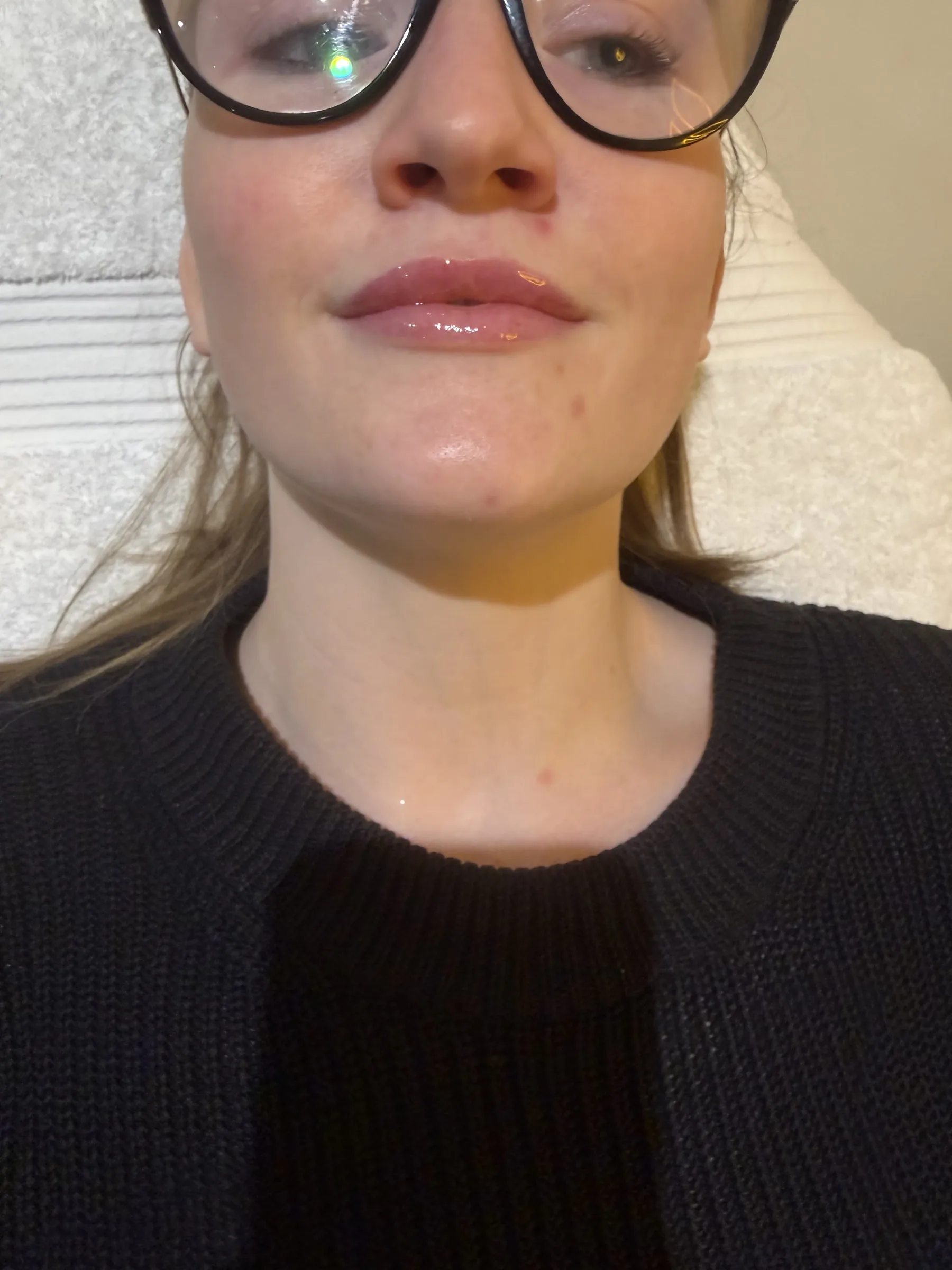 Core Aesthetics Oakleigh clinic facial volume and midface assessment consultation figure 9 supporting Related Pages To Read and areas of the face that may age first