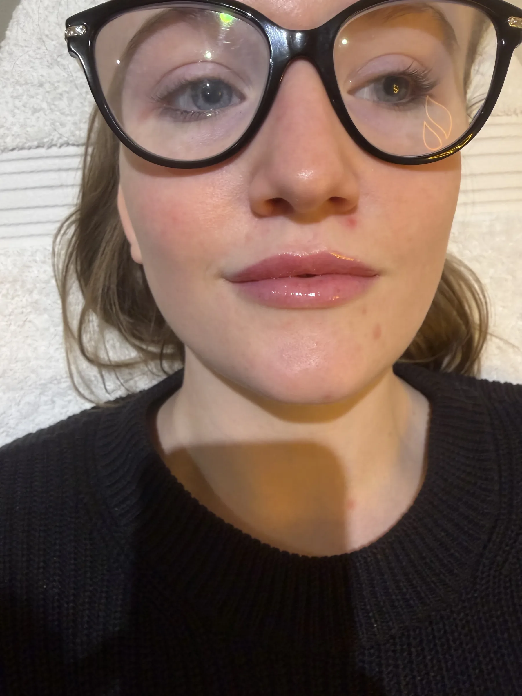Core Aesthetics Oakleigh clinic facial volume and midface assessment consultation figure 12 supporting Choosing Between Cheek, Under Eye And Full Face Advice and midface ageing and cheek support