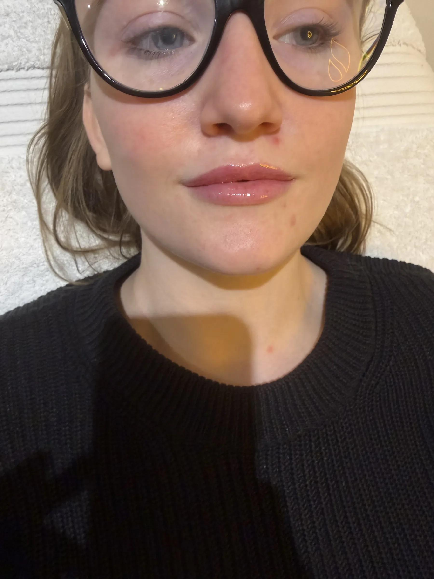 Front-on facial balance assessment during candidacy consultation at Core Aesthetics in Oakleigh