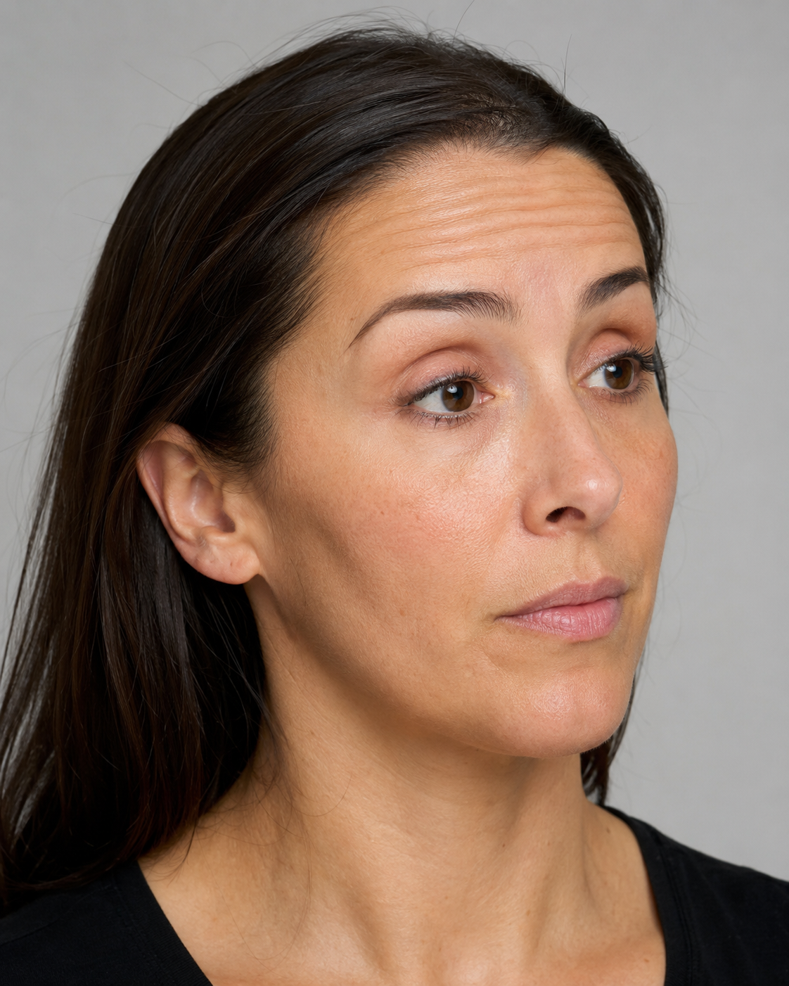 Wrinkle and upper-face consultation assessment for consultation planning at Core Aesthetics in Oakleigh