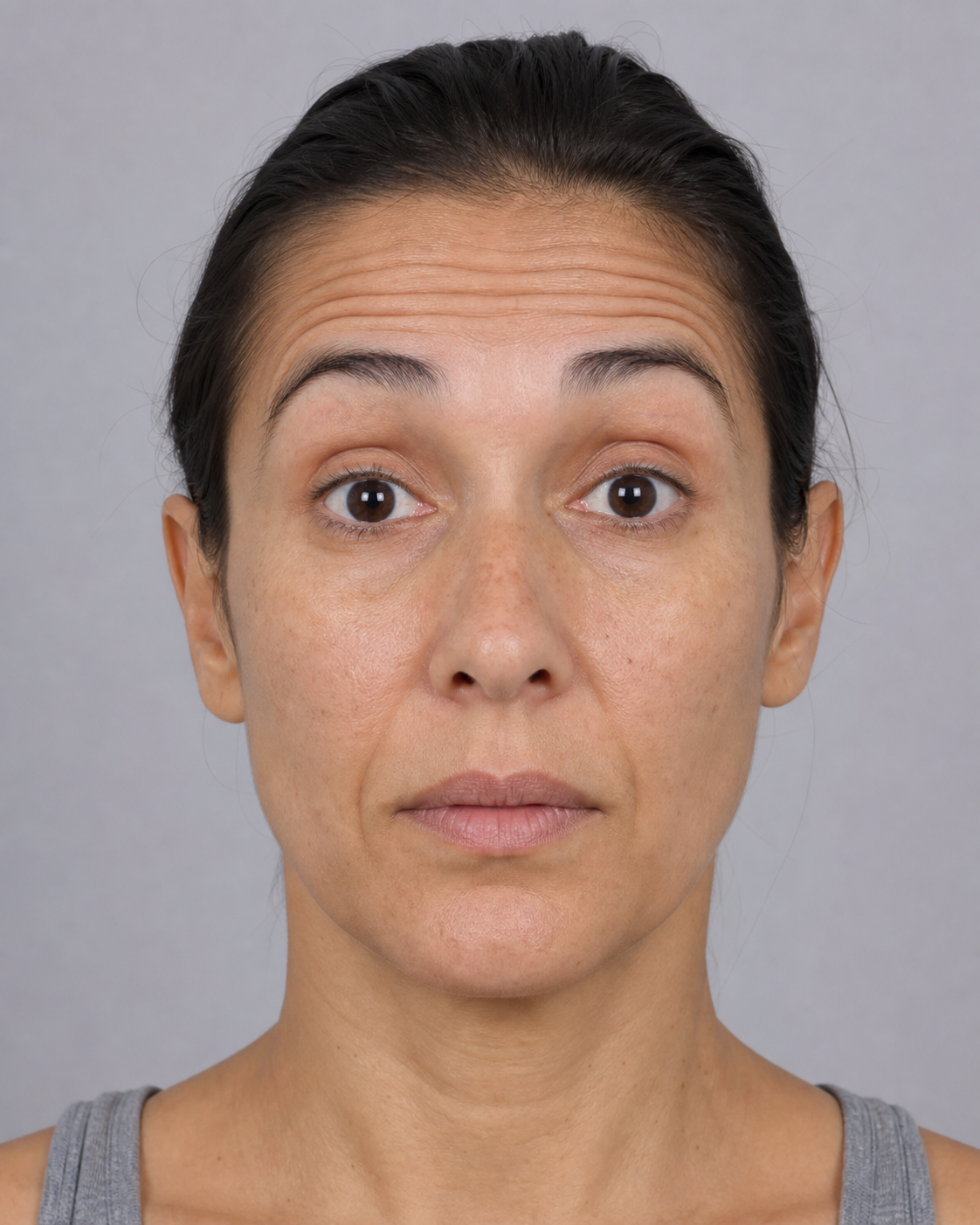 Forehead line assessment reference for forehead consultation at Core Aesthetics Oakleigh