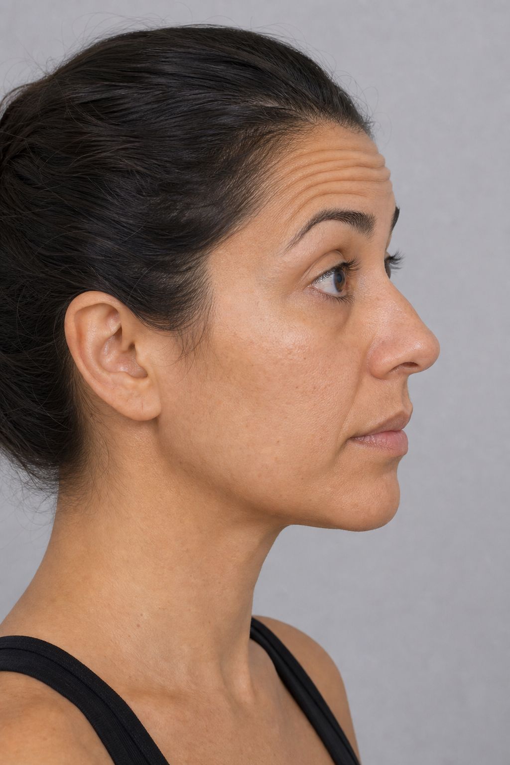 Wrinkle and upper-face consultation assessment for consultation planning at Core Aesthetics in Oakleigh