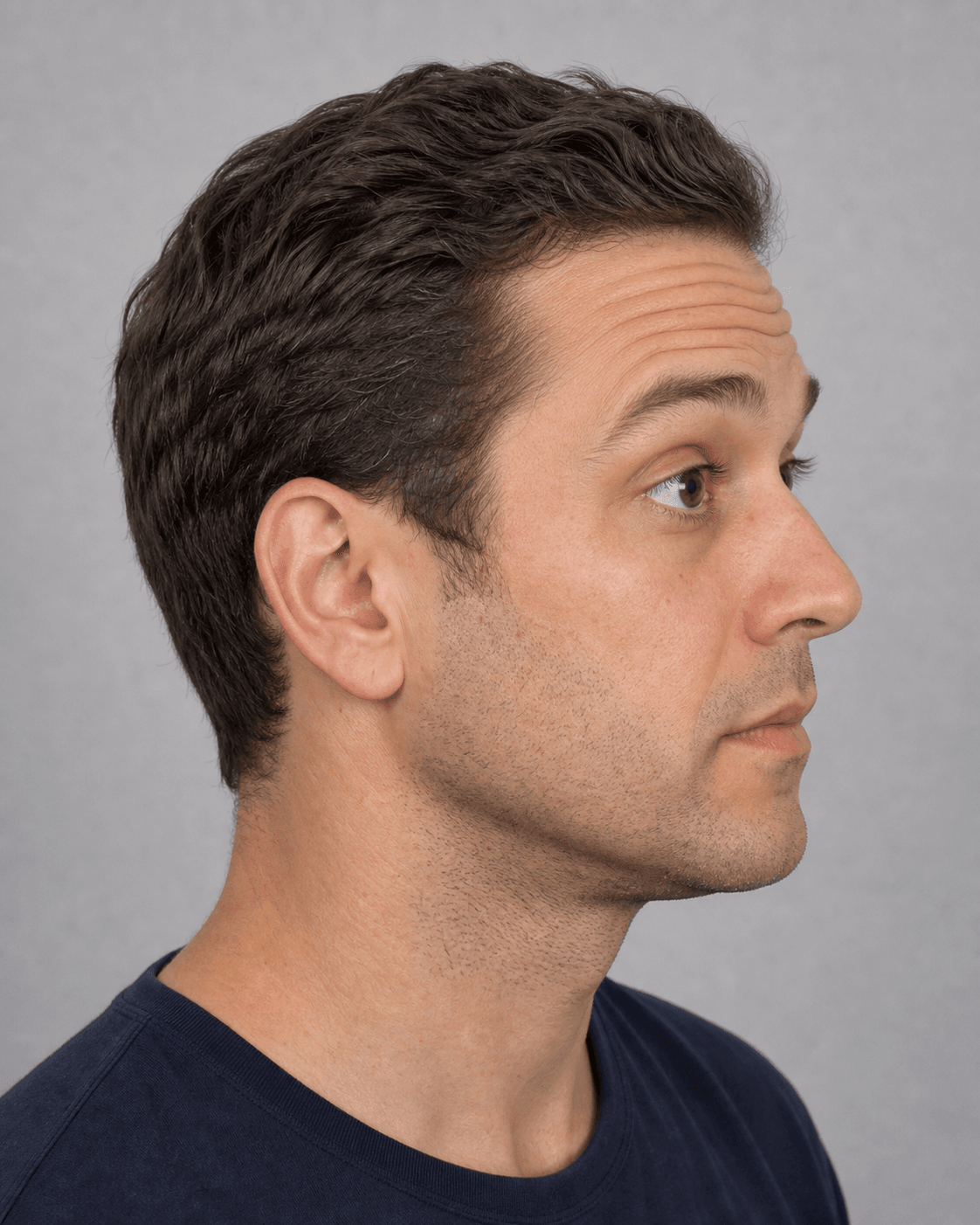 Side upper-face portrait for general forehead assessment information at Core Aesthetics in Oakleigh