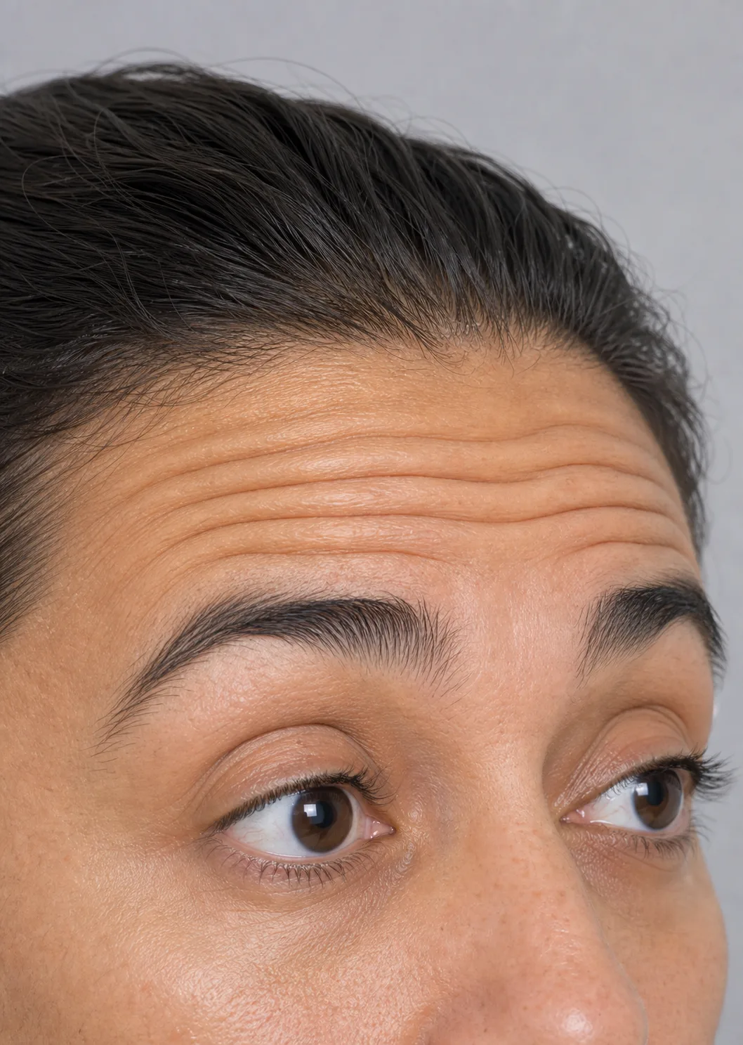 Neutral educational close view of raised brows and horizontal forehead folds during expression