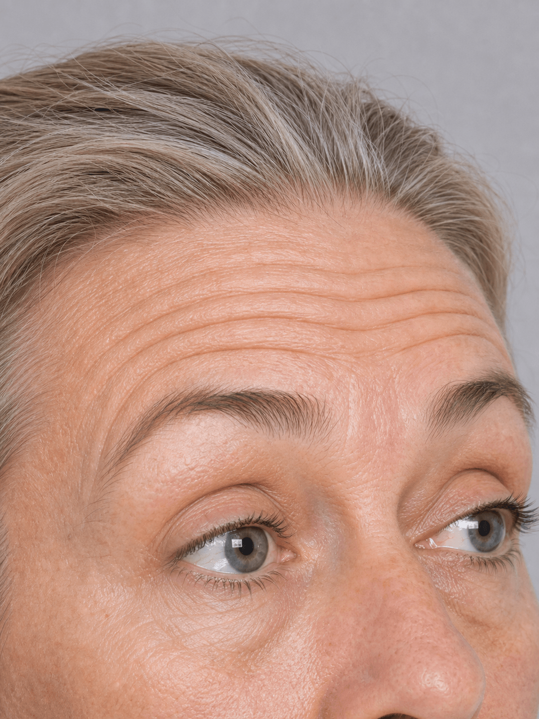 Close forehead line assessment reference for forehead lines consultation at Core Aesthetics Oakleigh