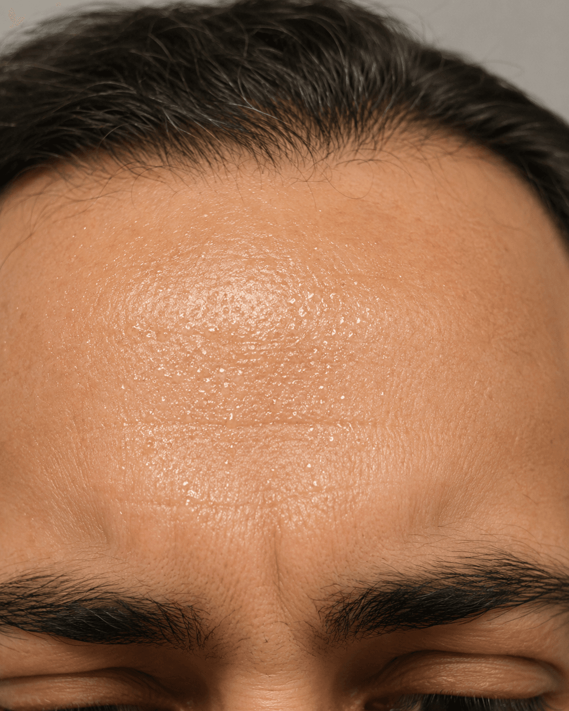 Underarm sweating consultation assessment for consultation planning at Core Aesthetics in Oakleigh
