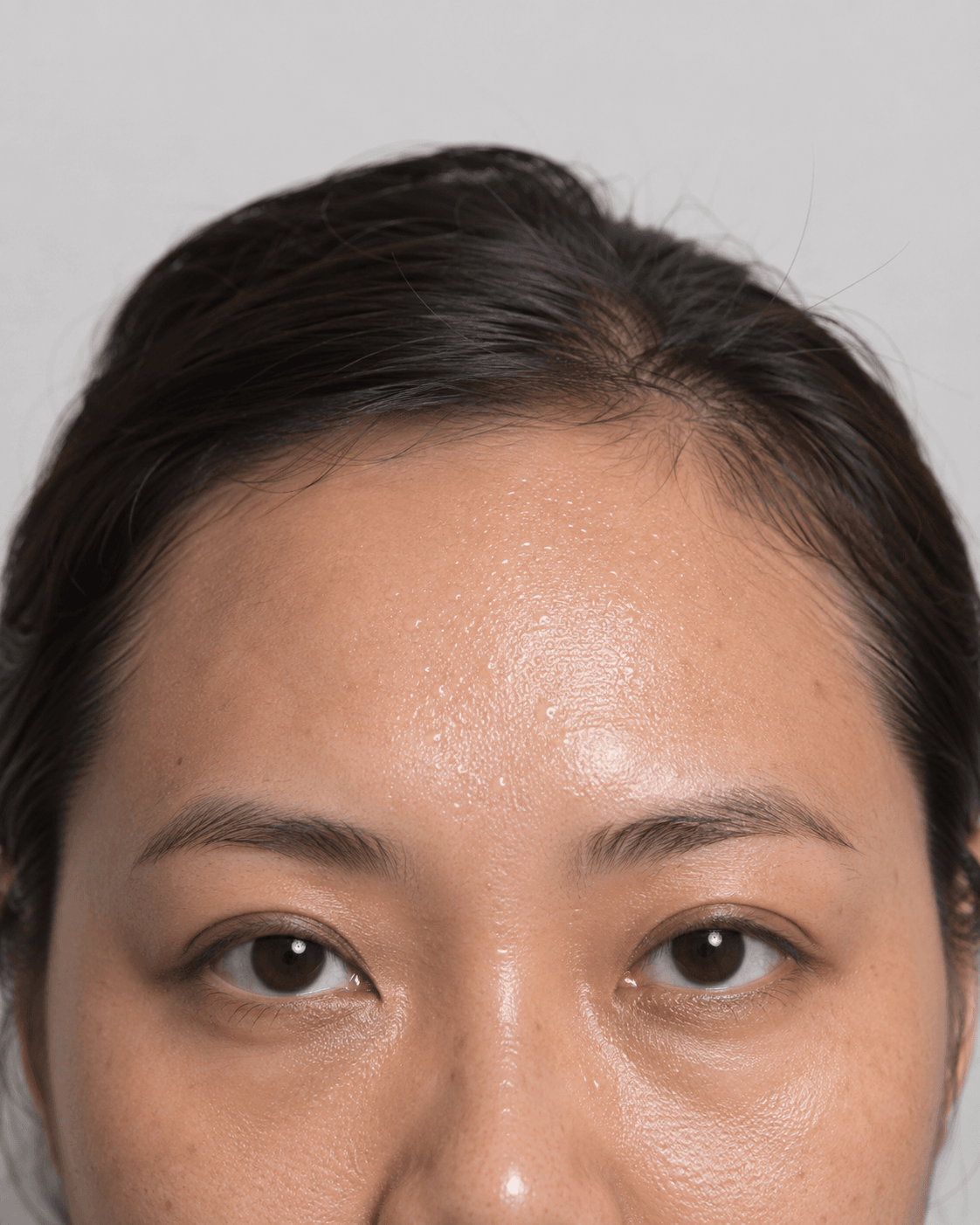 Underarm sweating consultation assessment for consultation planning at Core Aesthetics in Oakleigh