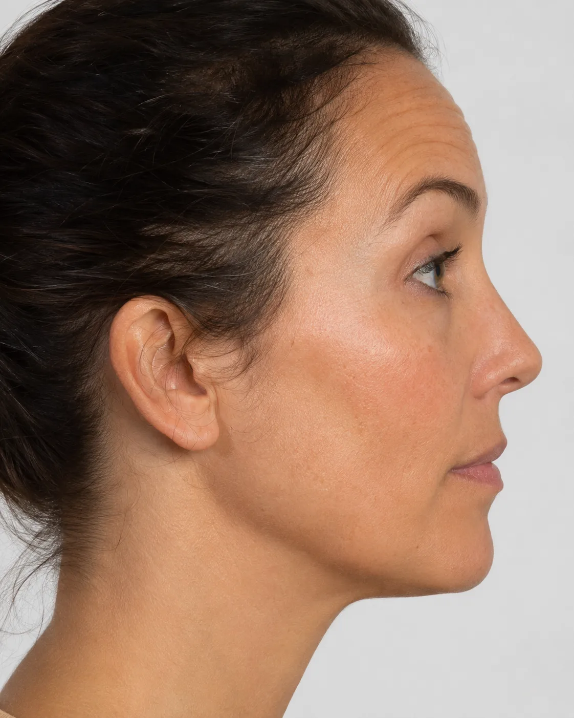 Side forehead view for observing natural brow lift as the eyes reopen near Wheelers Hill