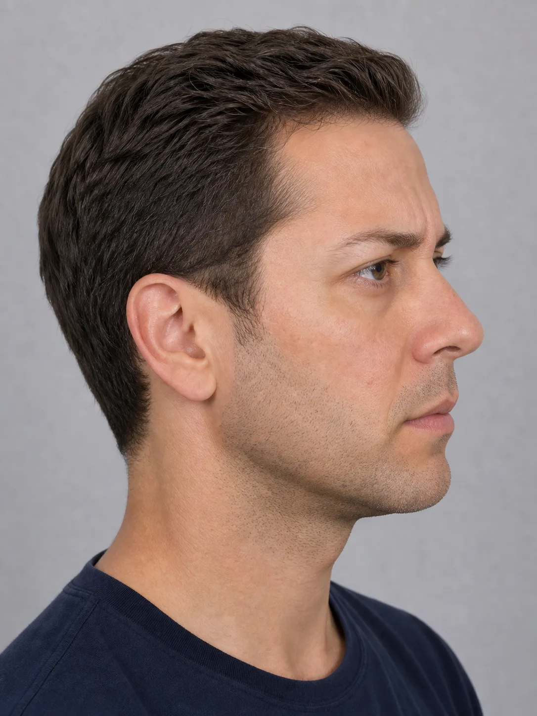 Side forehead and brow portrait shown for general information at Core Aesthetics in Oakleigh