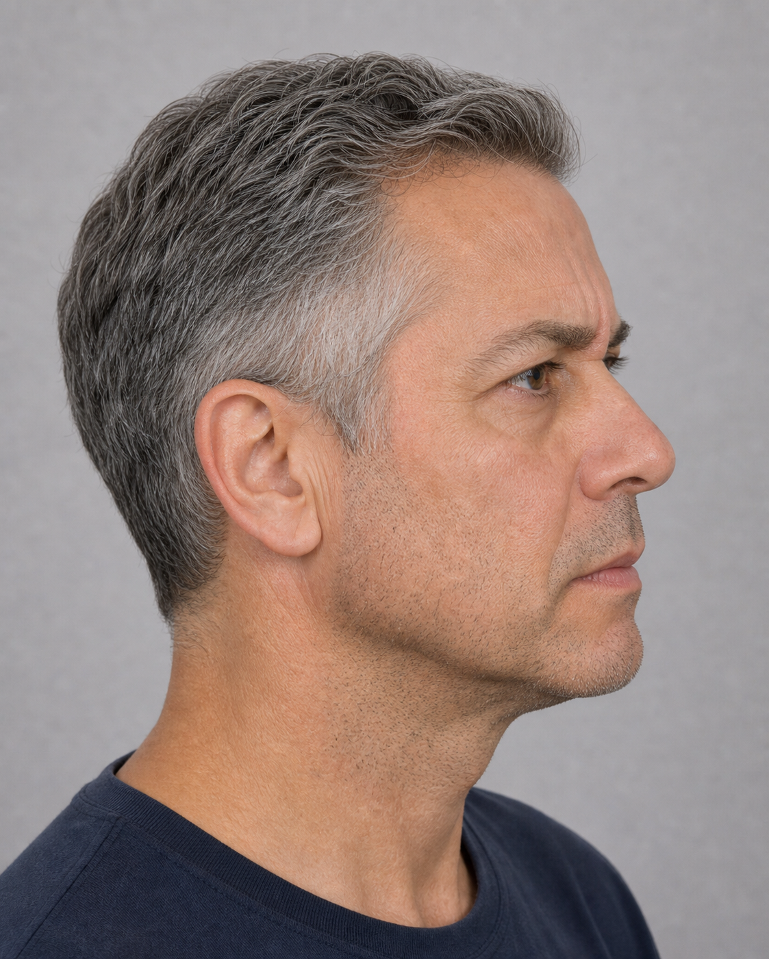 Upper face expression assessment context for Carnegie wrinkle treatment questions