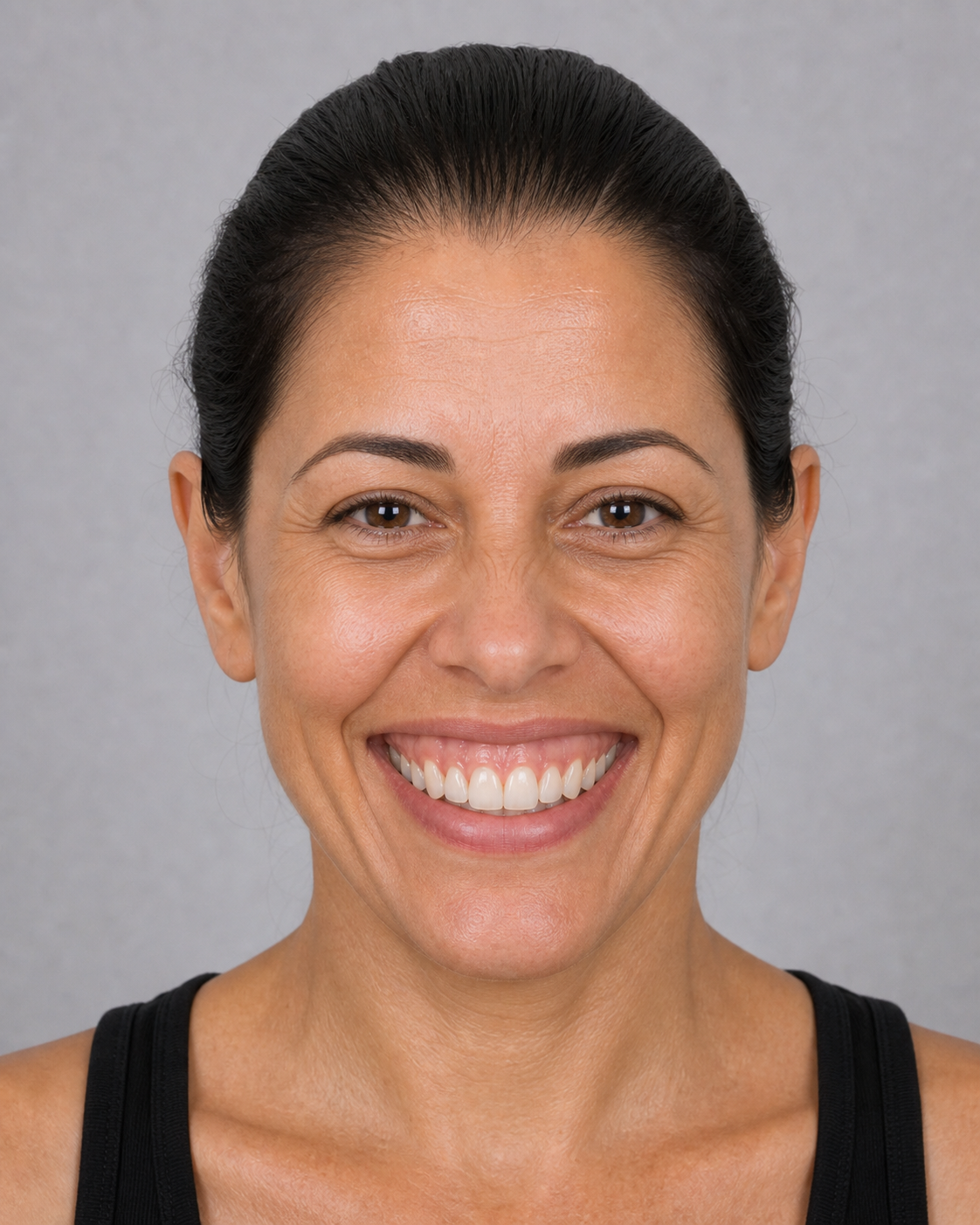 Lip and perioral consultation assessment for consultation planning at Core Aesthetics in Oakleigh