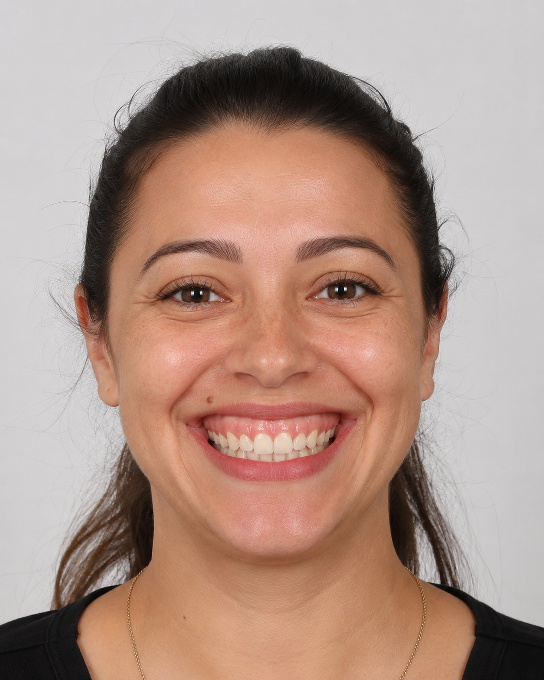 Smile dynamics assessment reference for gummy smile consultation at Core Aesthetics Oakleigh
