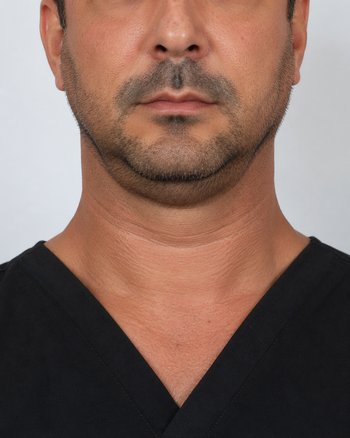 Wrinkle and upper-face consultation assessment for consultation planning at Core Aesthetics in Oakleigh