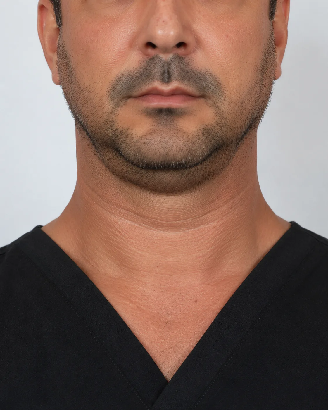 Wrinkle and upper-face consultation assessment for consultation planning at Core Aesthetics in Oakleigh