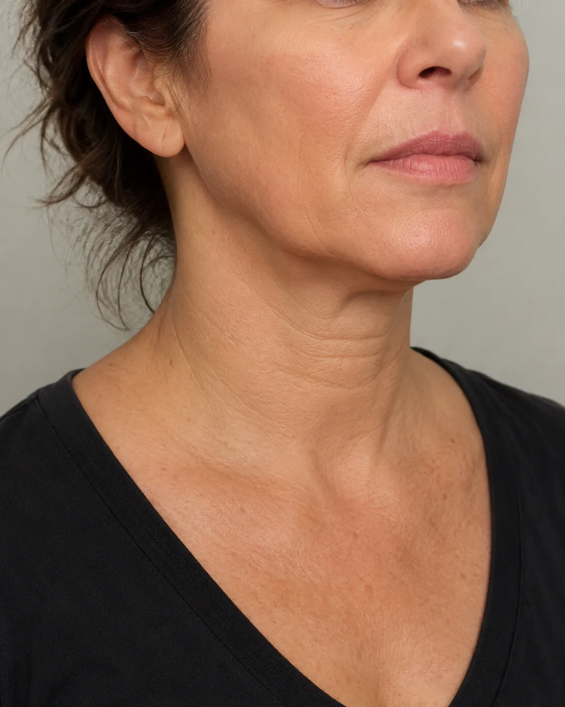 Adult patient viewed from an angle during a lower face consultation
