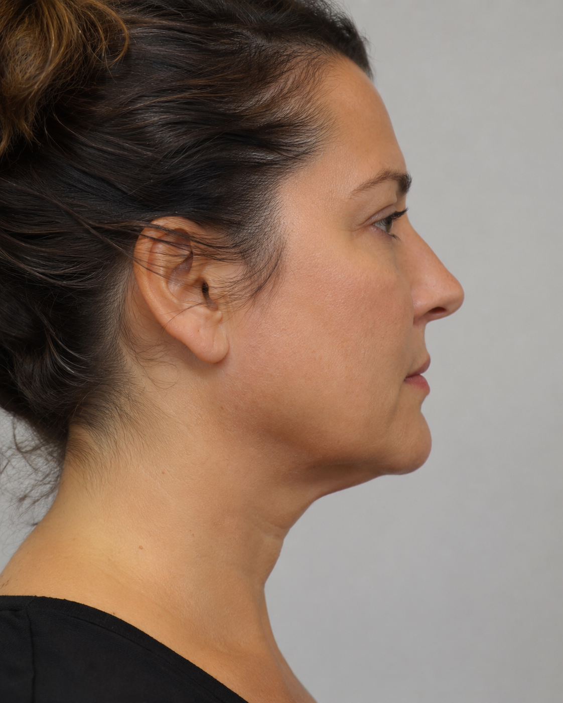 Facial structure consultation assessment for consultation planning at Core Aesthetics in Oakleigh