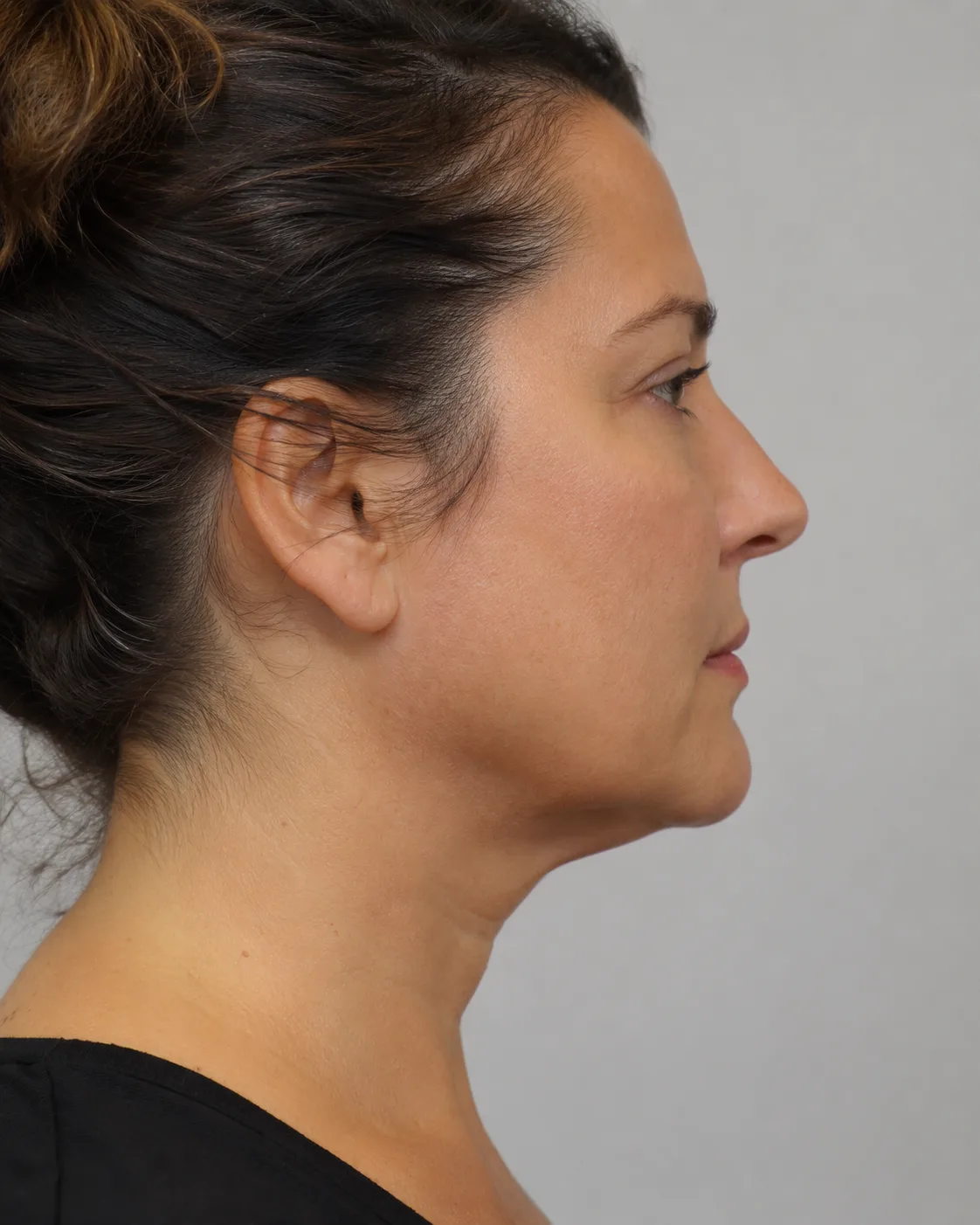 Aftercare and review consultation context for consultation planning at Core Aesthetics in Oakleigh