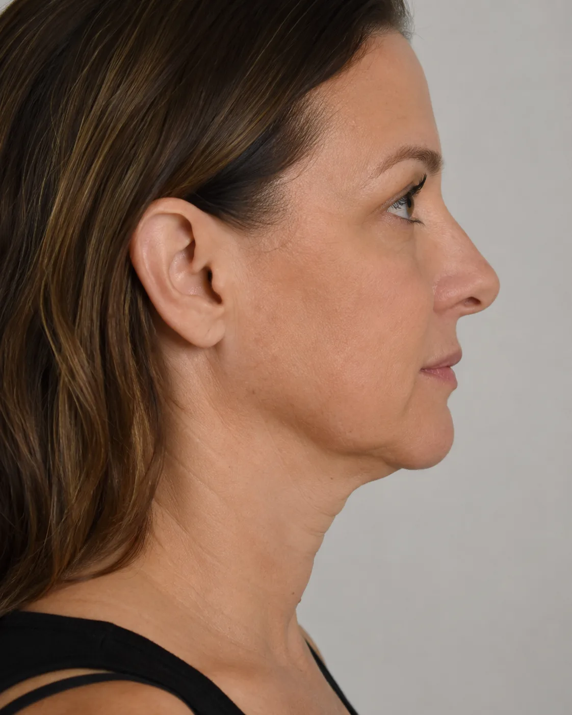 Adult patient in side view during a lower-face consultation assessment