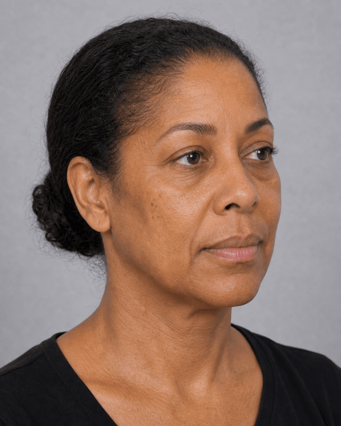 Adult woman in three-quarter view for a lip proportion consultation guide