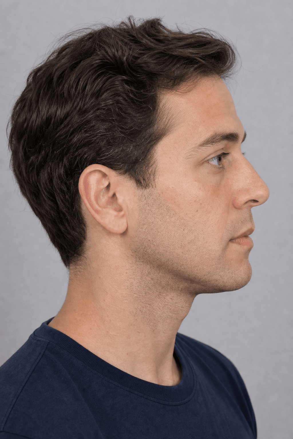 Lip and perioral consultation assessment for consultation planning at Core Aesthetics in Oakleigh